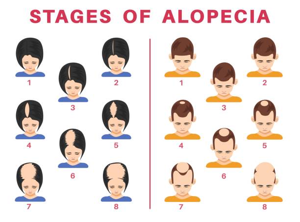 stockillustraties, clipart, cartoons en iconen met stages of alopecia in men and women vector illustrations set - haaruitval