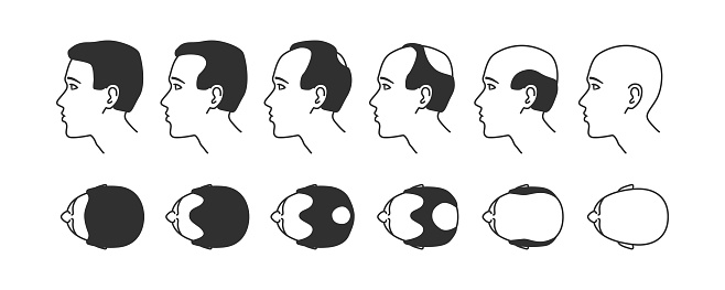Stages of baldness
