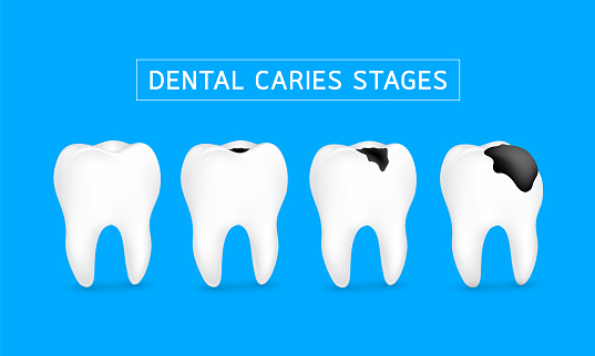  dental caries treatment cost