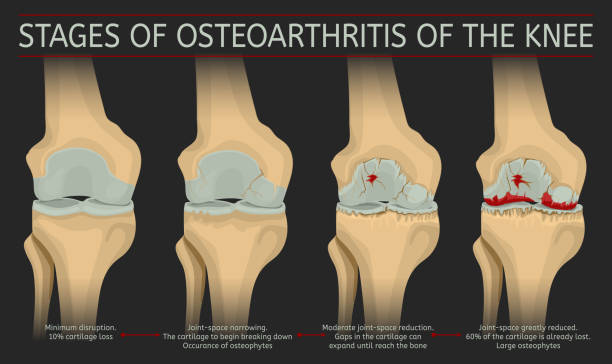Stages of osteoarthritis of the knee Stages of osteoarthritis of the knee. Editable vector illustration in realistic style isolated on a dark grey background. Medical, healthcare and physiology concept. Scientific infographic. osteoarthritis stock illustrations