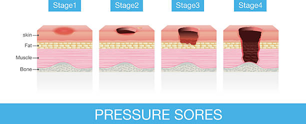 Stages of Pressure Sores Stages of Pressure Sores of patient skin which extends from skin into muscles and bone. This is medical illustration. tissue anatomy stock illustrations