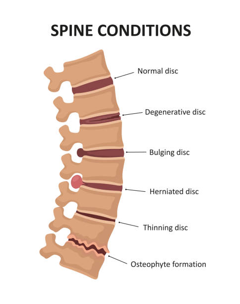 Stages of spinal osteochondrosis. Degenerative Disc. Bulging Disc. Herniated Disc. Thinning Disc Stages of spinal osteochondrosis. Degenerative Disc. Bulging Disc. Herniated Disc. Thinning Disc disk stock illustrations