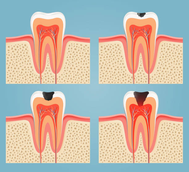 stages of tooth decay stages of tooth decay dental cavity stock illustrations