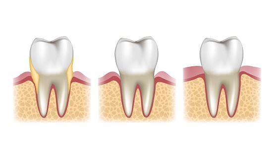 Stages of treatment of a tooth