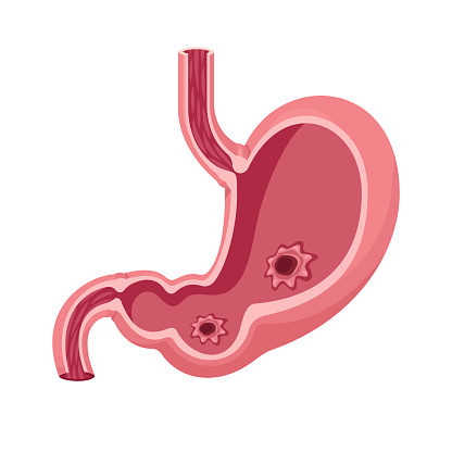 Stomach Ulcer Vector
