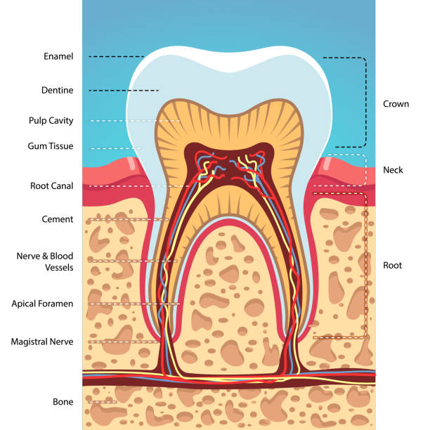 Signs that root canal is needed. A root cana requires one or more office visits and can be performed by a dentist or endodontist. An endodontist is a dentist who specialized in the causes, diagnos, prevention, and treatment of diseases and injuries of the human dental pulp or the nerve of the tooth. The choice of which type of dentist to use depends to some degree on the difficulty of the root canal procedure needed in your particular tooth and the general dentist's comform level in working on your tooth. Your dentist will discuss who might be best suited to perform the work in your particular case. The first step in the procedure is to take an X-ray to see the shape of the root canals and determine if there are any signs of infection in a surrounding bone. Your dentist or endodontist will then use local anesthesia to numb the area near the tooth. Anesthesia may not be necessary, since the nerve is dead, but most dentists still anesthetize the area to make the patient more relaxed and at ease. Next, to keep the area dry and free of saliva during treatment, your dentist will place a rubber dam (a sheet of rubber) around the tooth. An access hole will then be drilled into the tooth. The pulp along with bacteria, the decayed nerve tissue and related debris is removed from the tooth. The cleaning out process is accomplished using root canal files. A series of these files of increasing diameter are each subsequently placed into the access hole and worked down the full length of the tooth to scrape and scrub the sides of the root canals. Water or sodium hypochlorite is used periodically to flush away the debris. Embed Asset Override  Once the tooth is thoroughly cleaned, it is sealed. Some dentists like to wait a week before sealing the tooth. For instance, if there is an infection, your dentist may put a medication inside the tooth to clear it up. Others may choose to seal the tooth the same day it is cleaned out. If the root canal is not completed on the same day, a temporary filling is placed in the exterior hole in the tooth to keep out contaminants like saliva and food between appointments.
