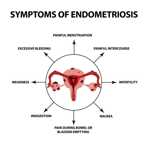 illustrations, cliparts, dessins animés et icônes de symptômes de l’endométriose. la structure des ovaires utérus. infographie. illustration vectorielle sur fond isolé - endométriose