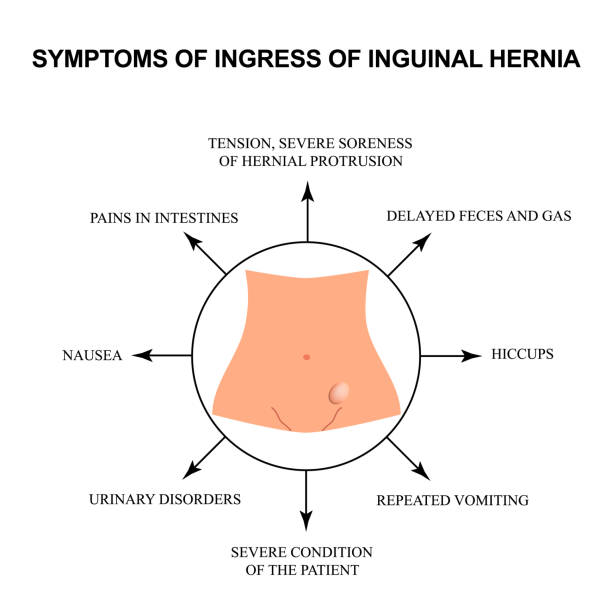 Symptoms of impaired inguinal hernia. Infographics. Vector illustration on isolated background. Symptoms of impaired inguinal hernia. Infographics. Vector illustration on isolated background hernia inguinal stock illustrations