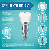 Teeth maquette. Structural elements of dental implant. Infographic for medicine poster. Vector dental poster, implant medical tooth illustration