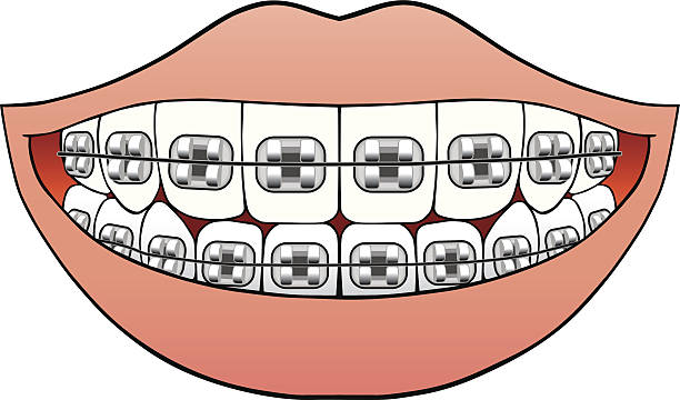 Download Royalty Free Braces Clip Art, Vector Images ...