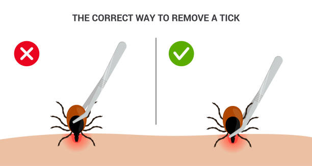stockillustraties, clipart, cartoons en iconen met the correct way to remove a tick insect correctly. tips for tick safety infographic - lyme