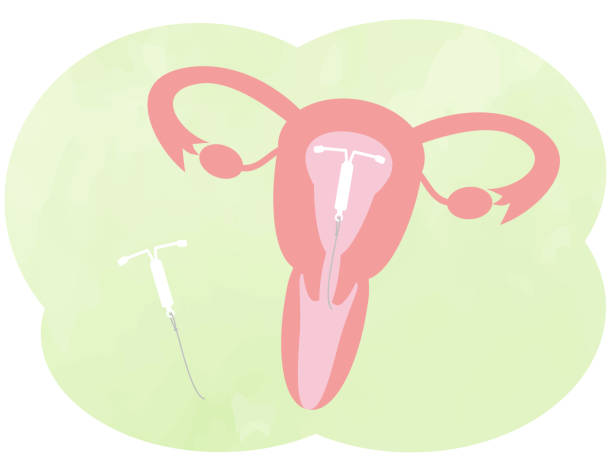 This is an illustration of an IUD (intrauterine device).  iud stock illustrations