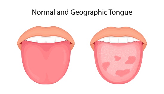 Tongue disease, organs concept vector.