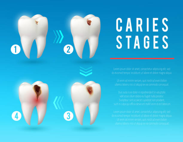 Tooth decay 3d poster of dental caries development Tooth decay 3d vector poster. Teeth on different stages of dental caries development. Enamel and dentin decay, pulp decay and pulp infection banner for dentist office, dentistry clinic design dental cavity stock illustrations