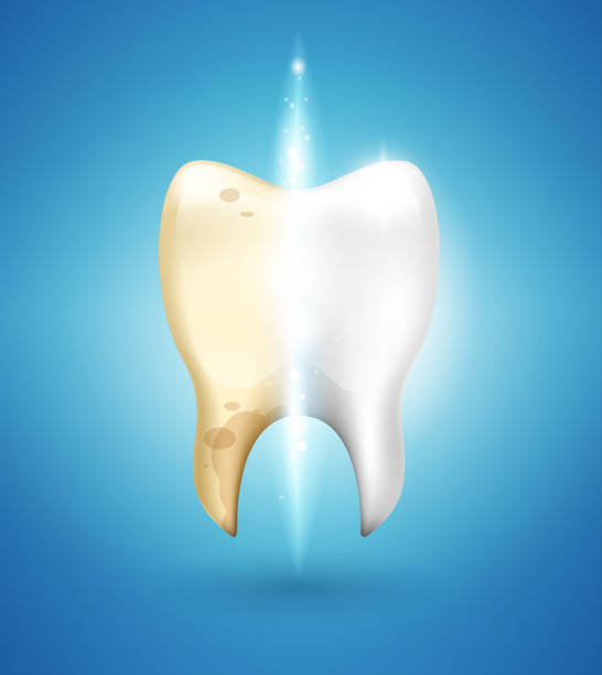 Tooth whitening in 3d style. Dental brushing of calculus and caries removal. Difference after brushing. Vector realism illustration. Tooth whitening in 3d style. Dental brushing of calculus and caries removal. Difference after brushing. Vector realism illustration. half happy half sad stock illustrations