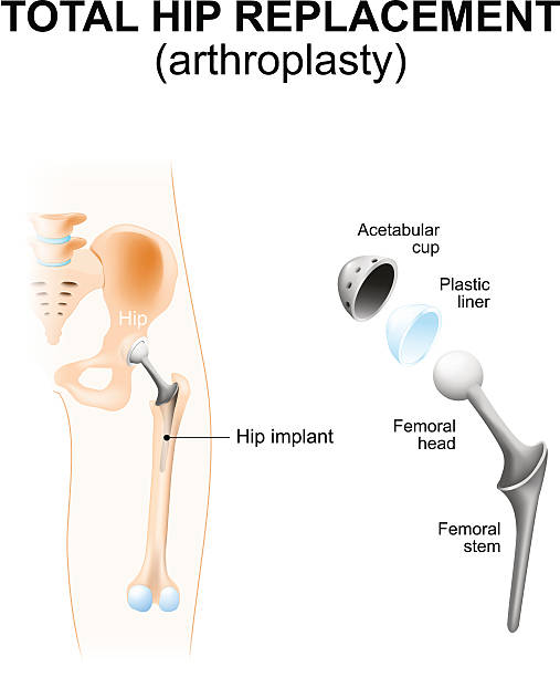 Total hip replacement or arthroplasty. Total hip replacement or arthroplasty and hip Implant hip body part stock illustrations