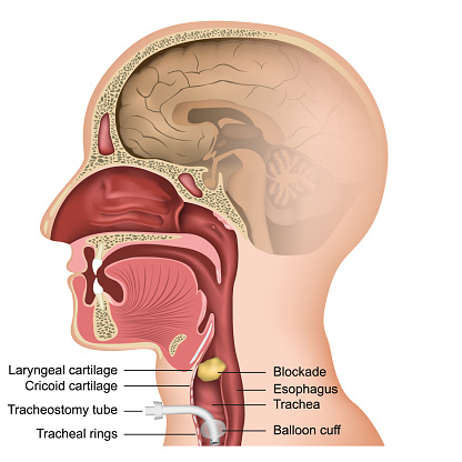 Tracheotomy medical vector illustration on white background
