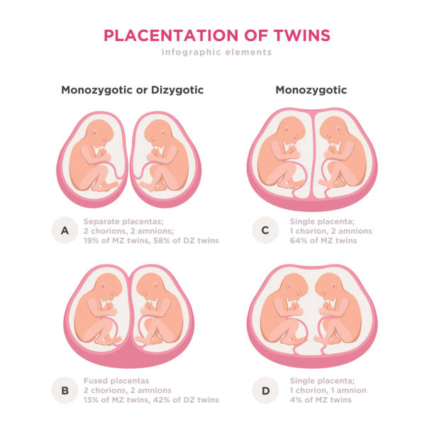 Twin types infographic elements in flat design. Monozygotic or Dizygotic Placentation of twins medical illustration and icons isolated on white background. Twin types infographic elements in flat design. Monozygotic or Dizygotic Placentation of twins medical illustration and icons isolated on white background twins stock illustrations