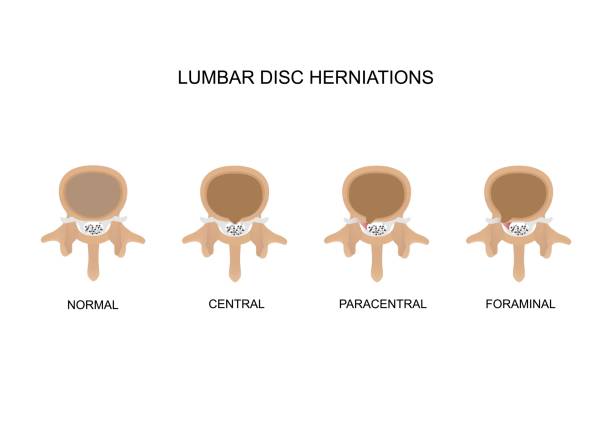 Type of lumbar disc herniations vector art illustration