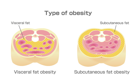 Type of obesity illustration. Abdominal sectional View. (visceral fat , subcutaneous fat)
