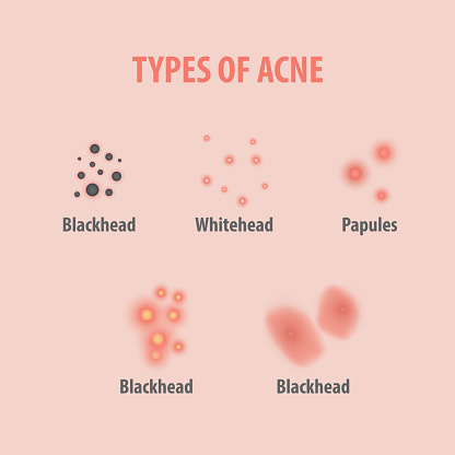Types Of Acne Illustration Vector On White Background Beauty Concept ...