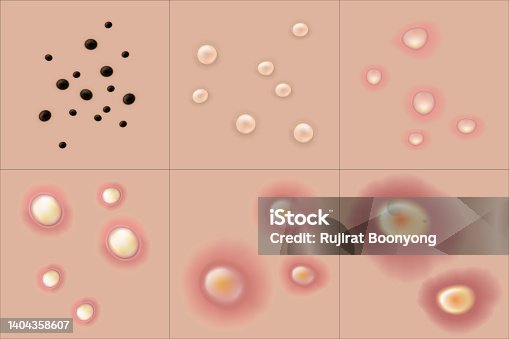 istock Types of acne. Skin problems. Blackheads, Whiteheads, Papules, Pustules, Nodules and cystics. Vector for advertising about beauty and medical treatment. 1404358607