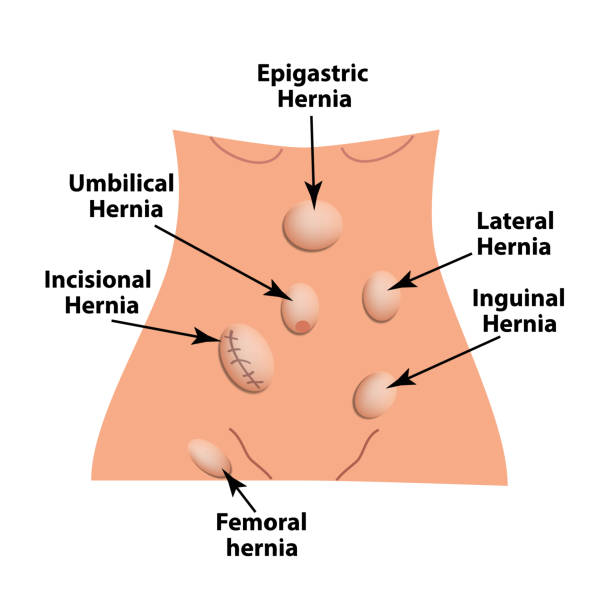 Types of hernia. Epigastric, Lateral, Umbilical, Inguinal, femoral, incisional hernia. intestinal hernia. Infographics. Vector illustration on isolated background. Types of hernia. Epigastric, Lateral, Umbilical, Inguinal, femoral, incisional hernia. intestinal hernia Infographics Vector illustration on isolated background hernia inguinal stock illustrations