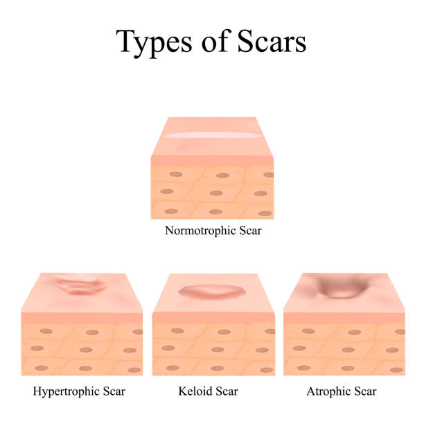 /types-of-scars-acne-scars