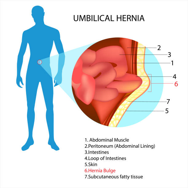 Umbilical hernia. Infographic Umbilical hernia. Infographic hernia inguinal stock illustrations