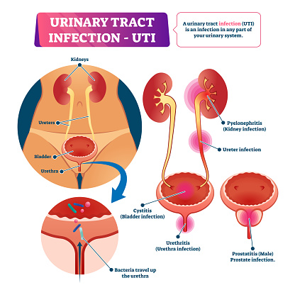 a prostatitis urethritis)