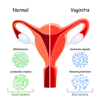Vaginal flora. Good and bad bacteria that colonize vagina