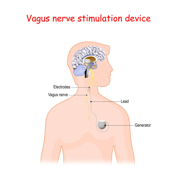 vagus nerve stimulation device. vagus nerve stimulation device. vector diagram for medical use vagus nerve stock illustrations
