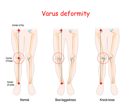 valgus deformities. healthy joint, knock-knee and Bow-leggedness
