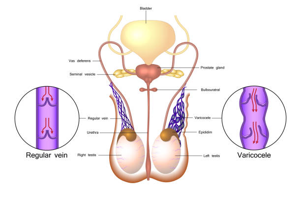 Varicocele in testicular vessels Varicocele in male reproductive system varicocele stock illustrations