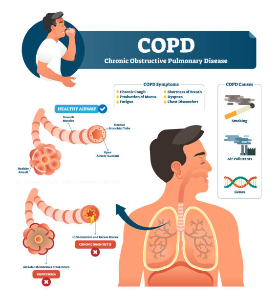 COPD vector illustration. Labeled chronic obstructive pulmonary explanation COPD vector illustration. Labeled chronic obstructive pulmonary disease explanation. Lungs inflammation symptoms and causes diagram. Compared healthy airways and emphysema or bronchitis type sickness. chronic pain stock illustrations