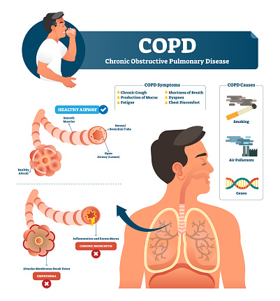 Copd Vector Illustration Labeled Chronic Obstructive Pulmonary ...