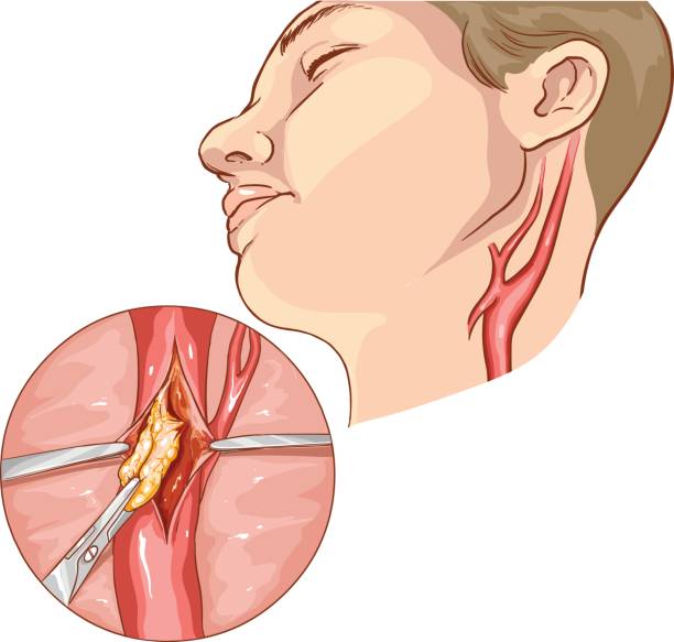 vector illustration of a Carotid Endarterectomy vector illustration of a Carotid Endarterectomy vagus nerve stock illustrations