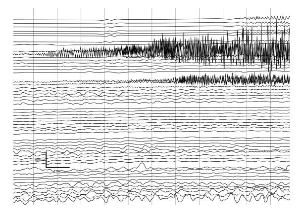 Vector Illustration of ictal EEG recording during seizure. Vector Illustration of ictal EEG recording during seizure. Seizure waves showing propagation of high amplitudes and frequency waves. electrode stock illustrations
