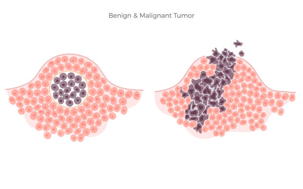 Benign cancer spots Cancer benign tissue