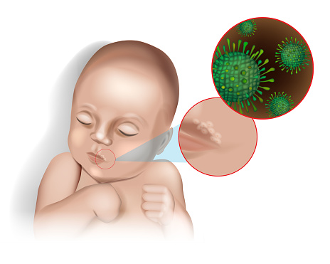 Vector illustration of the herpes virus on the lip of a child.Acute herpetic stomatitis in children. Infectious viral disease Herpes simplex virus.