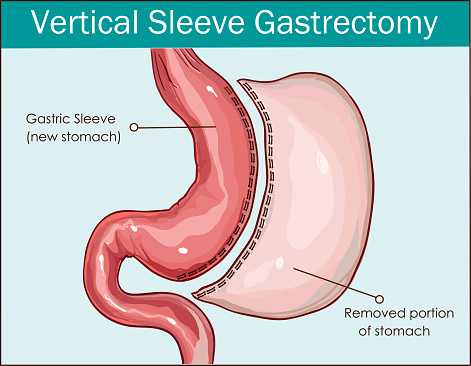 Vector illustration of Vertical Sleeve Gastrectomy