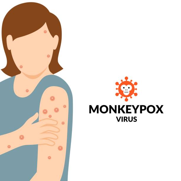 vector illustration, woman exposed to monkeypox virus, as an educational poster or banner. - 猴痘 幅插畫檔、美工圖案、卡通及圖標
