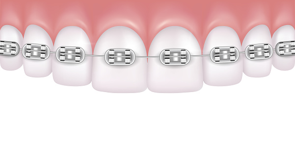 Download Vector Realistic Perfect White Teeth With Braces Isolated ...