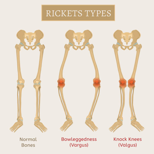 Vector Rickets Scheme Normal bones versus Rickets and Osteomalacia. Types of disease. Medical, anatomy and biology concept. Educational vector illustration isolated on a white background. knobby knees stock illustrations