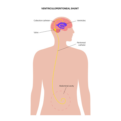 Ventriculoperitoneal shunt. Ventricular system anatomy, communicating cavities within the brain. Cerebral ventricles, production, transport and removal of cerebrospinal fluid flat vector illustration