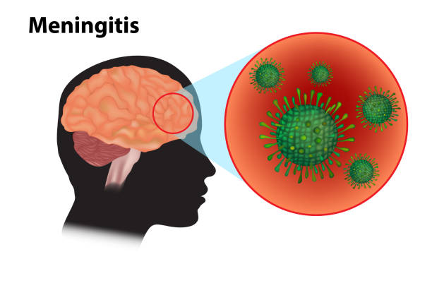 ilustraciones, imágenes clip art, dibujos animados e iconos de stock de la meningitis viral y la encefalitis - listeria
