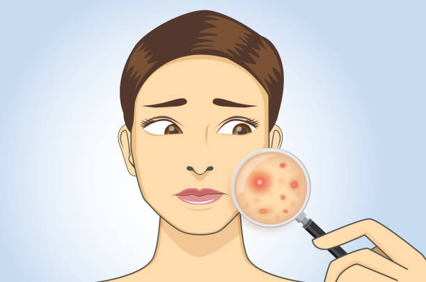 Severe acne removal videos