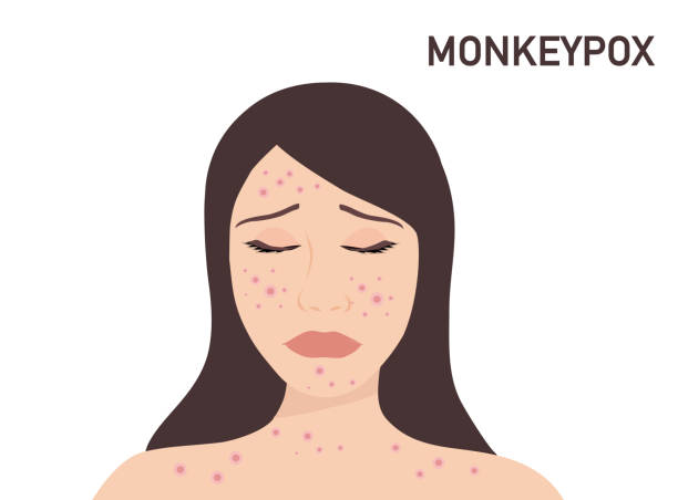 그녀의 얼굴 벡터 일러스트레이션에 새로운 바이러스 원숭이 두 감염으로 고통받는 여성. 천연두 바이러스 개념 - monkey pox stock illustrations