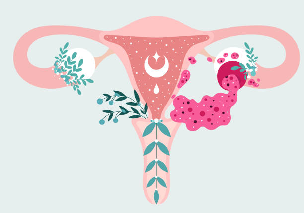 婦女健康 - 卵巢囊腫破裂與洩漏的液體的花卉資訊圖。奧瓦里病患者友好計劃。婦科問題 - 中性醫學圖子宮和子宮附屬物 - 人類性行為 插圖 幅插畫檔、美工圖案、卡通及圖標