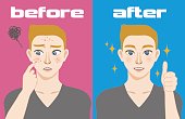 young boy acne treatment before and after, facial cleansing foam, men's skin care, cartoon illustration